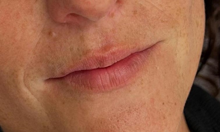Lippenpigmentierung mit softer Kontur und gleichmäßigem Farbverlauf – vorher